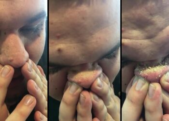 Comment enlever Comedon blanc ?