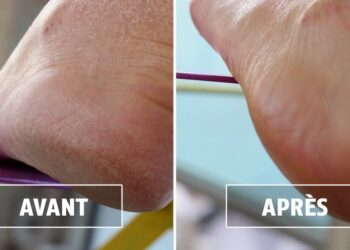 Comment enlever la corne Epaisse des pieds ?