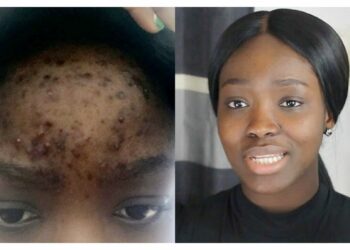 Comment enlever les taches noires sur les doigts naturellement ?