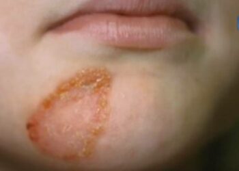 Comment eviter la propagation de la teigne ?