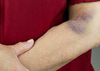 Comment faire pour avoir un bleu ?