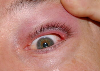 Comment retirer un bouton blanc sur la paupière ?