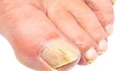 Comment s'appelle le traitement Spa des pieds ?