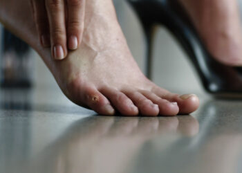 Comment se débarrasser des callosités des pieds ?