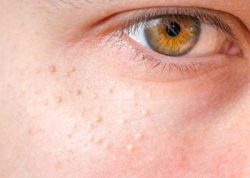 Comment se débarrasser des grains de milium sur le visage ?