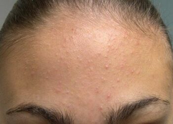 Comment se débarrasser des microkystes naturellement ?