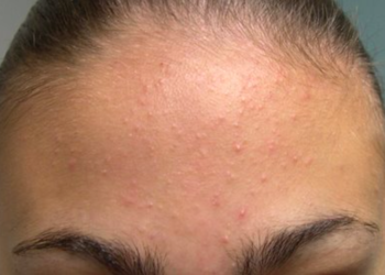 Comment se débarrasser des points blancs sur le visage ?