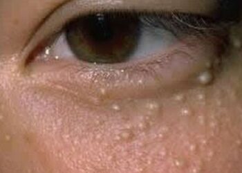 Comment se débarrasser des vers blancs sur le visage ?