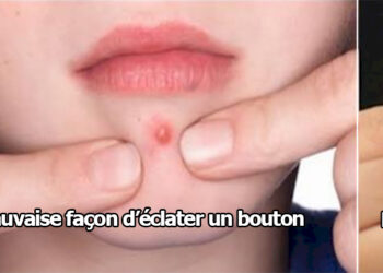 Comment se débarrasser d'un bouton blanc sans le percer ?