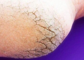 Comment soigner des callosités ?