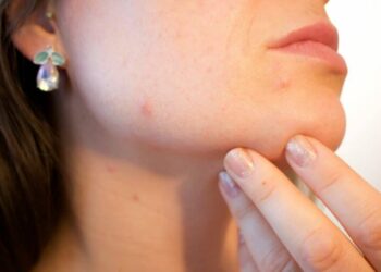Comment soigner la peau marbrée ?