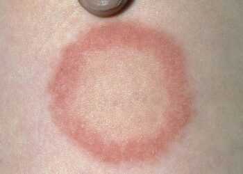 Comment stopper la teigne ?