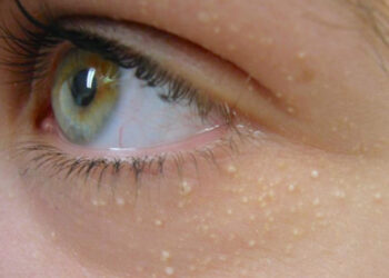 Est-ce que les grains de milium disparaissent ?