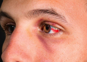 Est-il dangereux d'avoir l'œil rouge ?