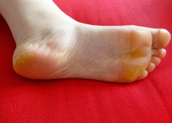 Pourquoi j'ai de la corne au pied ?