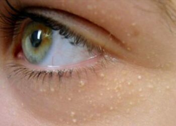Pourquoi j'ai des grain de Milium ?
