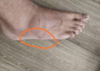 Pourquoi j'ai une boule sous le pied ?