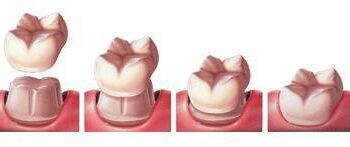 Pourquoi mettre une couronne transitoire ?