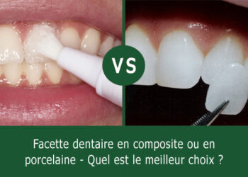 Quand changer un composite dentaire ?