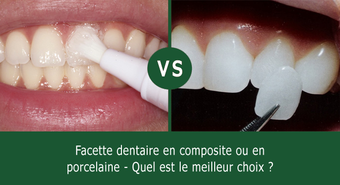 Quand changer un composite dentaire