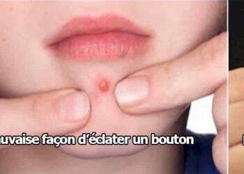 Quand le bouton est blanc Faut-il le percer ?