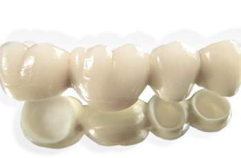 Quelle différence entre couronne céramique et zircone ?