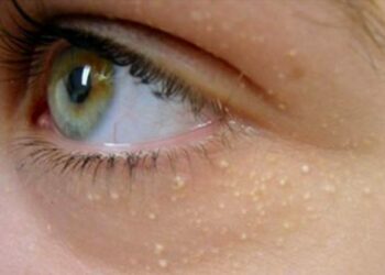 Quelles sont les causes des grains de milium ?