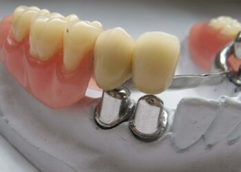 Quelles sont les nouvelles prothèses dentaires ?